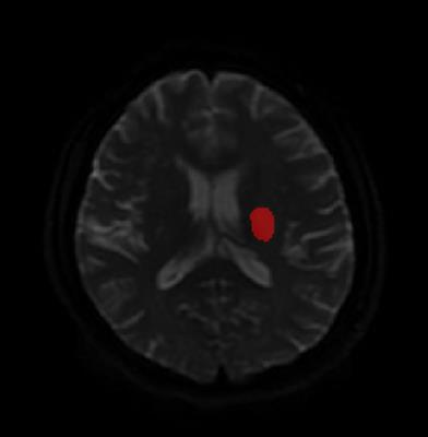 Altered Brain Function Activity in Patients With Dysphagia After Cerebral Infarction: A Resting-State Functional Magnetic Resonance Imaging Study